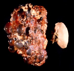 A Polycystic Kidney on the left, a healthy kidney on the right